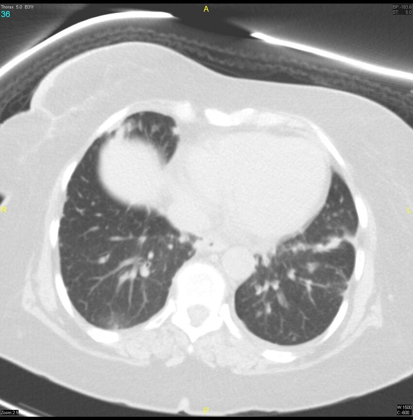 Breast primary with lung and bone metastases (Radiopaedia 40620-43228 Axial lung window 36).jpg