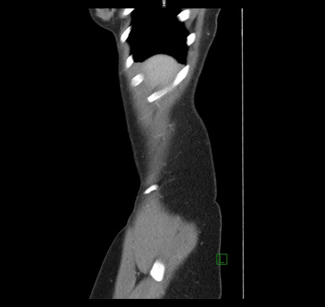 File:Broad ligament hernia (Radiopaedia 63260-71832 C 3).jpg