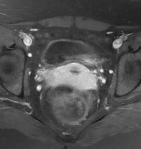 File:Broad ligament leiomyoma (Radiopaedia 81634-95516 Axial T1 C+ fat sat 16).jpg