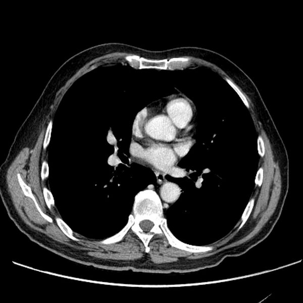 File:Bronchogenic carcinoma with L1 vertebra metastasis (Radiopaedia 9096-9805 Axial C+ delayed 18).jpg