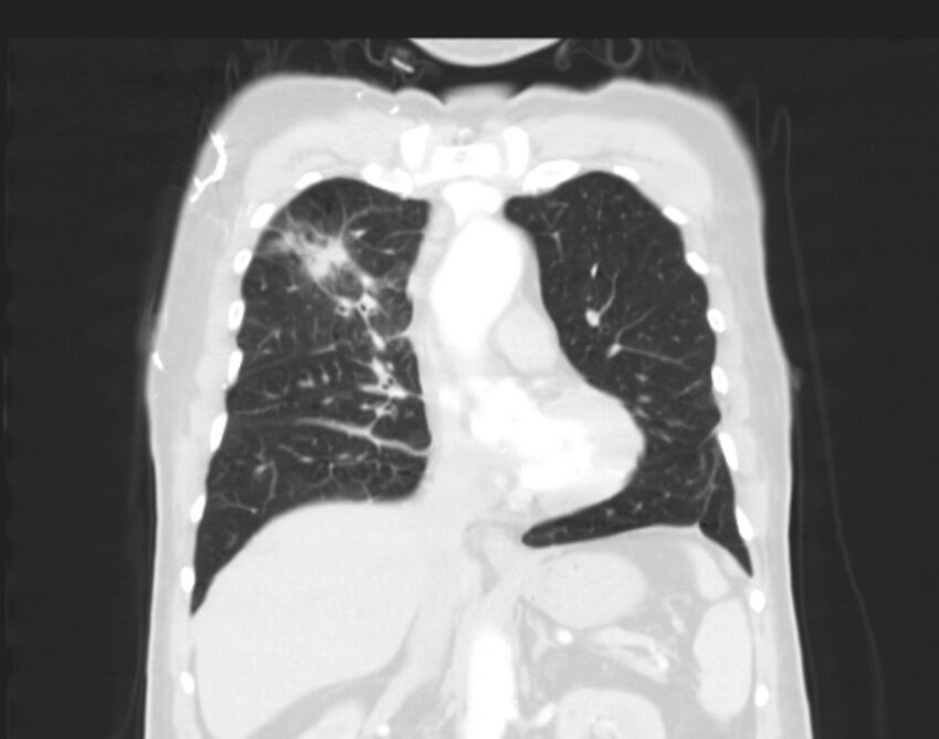 Bronchogenic carcinoma with lymphangitic spread (Radiopaedia 29002-29357 Coronal lung window 27).jpg