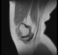 Bucket handle tear - medial meniscus (Radiopaedia 24900-25163 Sagittal T2 2).png