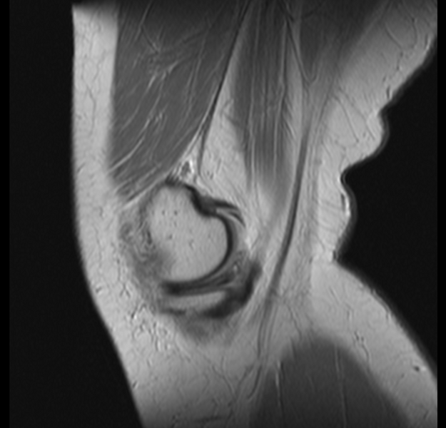 File:Bucket handle tear - medial meniscus (Radiopaedia 24900-25163 Sagittal T2 2).png