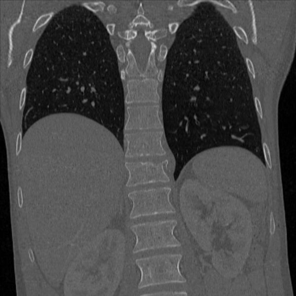 File:Bulging of paraspinal line in traumatic thoracal spinal compression fracture (Radiopaedia 29221-35872 Coronal bone window 21).jpg