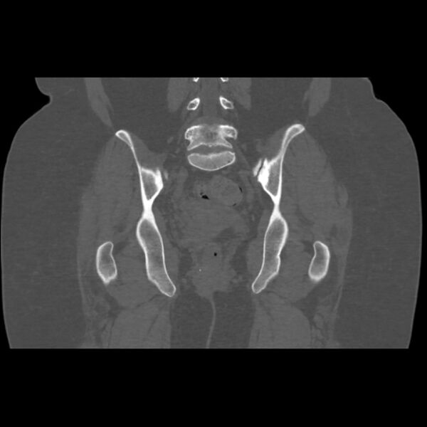 File:Calcific tendinitis of the gluteus medius muscle (Radiopaedia 66998-76318 Coronal bone window 37).jpg