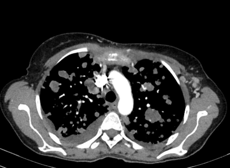 File:Cannonball metastases from breast cancer (Radiopaedia 91024-108569 A 38).jpg