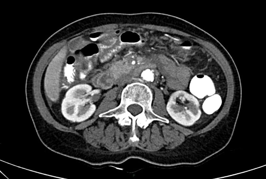 Carcinoid mesenteric tumor complicated by chylous ascites (Radiopaedia 76312-88926 A 33).jpg