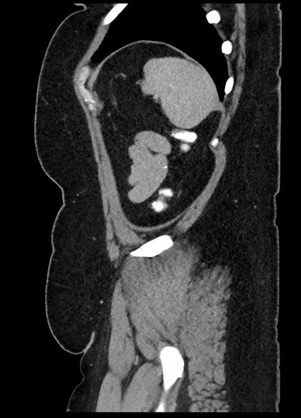 File:Carcinoid tumor - terminal ileum (Radiopaedia 60931-68739 C 4).jpg