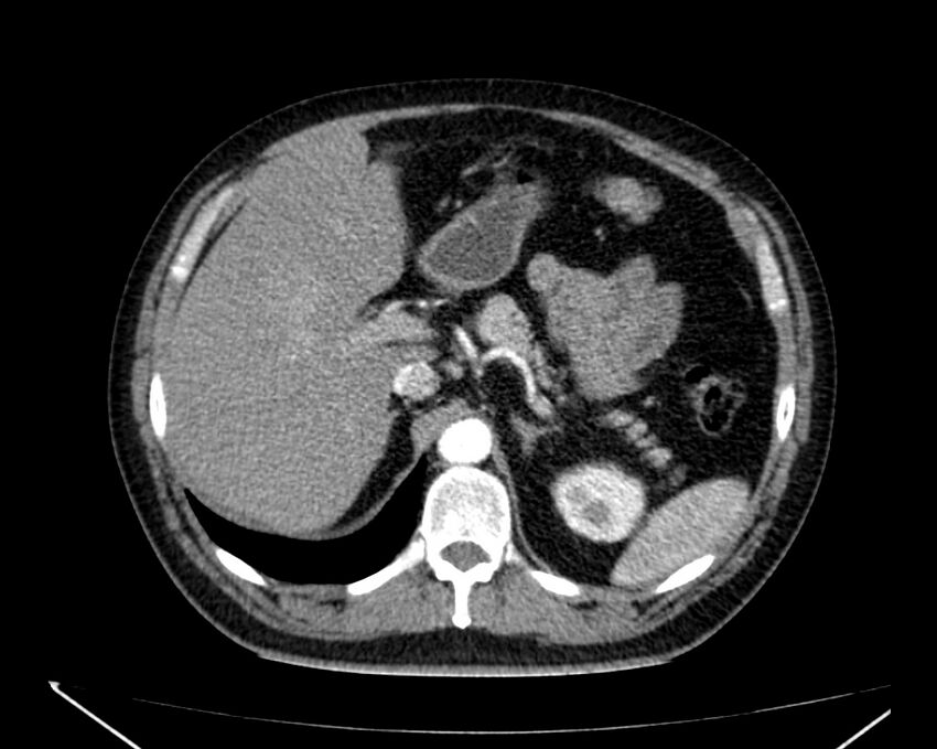 Carcinoid tumor with hepatic metastases (Radiopaedia 22651-22670 B 24).jpg