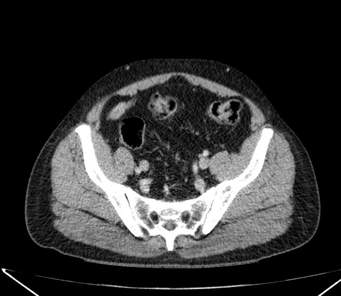 File:Carcinoid tumor with hepatic metastases (Radiopaedia 22651-22670 C 66).jpg