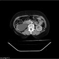 Carcinoma cervix- recurrence (Radiopaedia 34702-36137 B 23).jpg