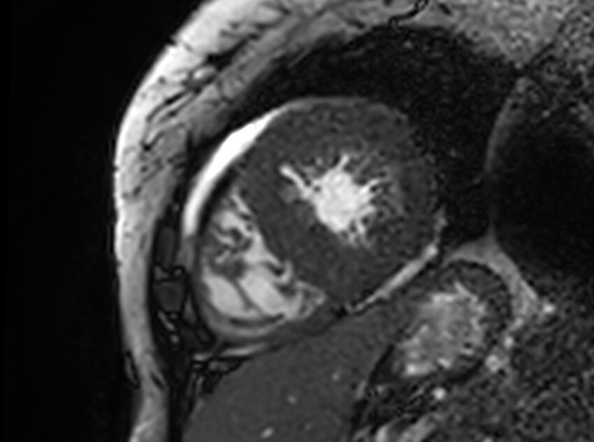 Cardiac amyloidosis (Radiopaedia 61600-69579 Short axis bSSFP 93).jpg