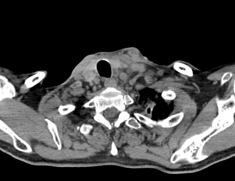File:Carotid artery pseudoaneurysm (Radiopaedia 84030-99259 Axial non-contrast 50).jpg