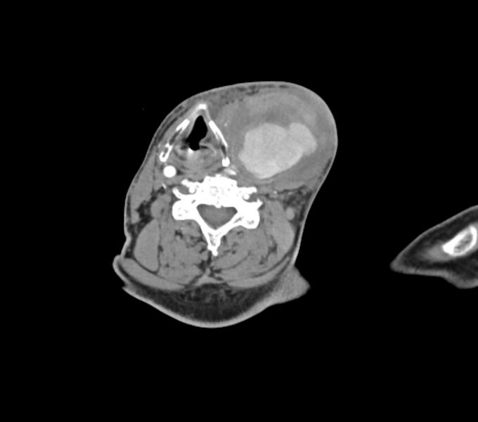File:Carotid artery pseudoaneurysm (Radiopaedia 84030-99259 C 50).jpg
