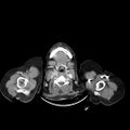 Carotid body tumor (Radiopaedia 21021-20948 A 19).jpg