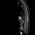 Caudal regression syndrome (Radiopaedia 61990-70072 Sagittal T2 TIRM 3).jpg