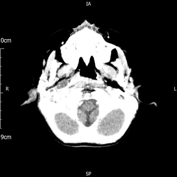 File:Cavernous sinus thrombosis (Radiopaedia 79414-92510 Axial Brain 48).jpg