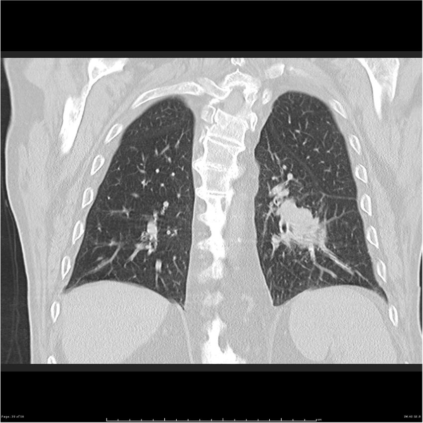 Cavitating left lower lobe lesion - squamous cell lung cancer (Radiopaedia 27749-28176 Coronal lung window 39).jpg
