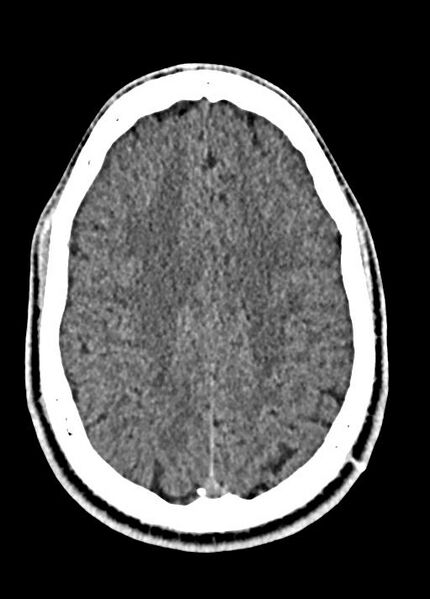 File:Cavum septum pellucidum and cavum vergae (Radiopaedia 77797-90060 Axial Brain Window 76).jpg