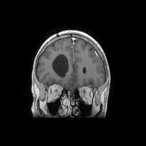 File:Central neurocytoma (Radiopaedia 67618-77021 Coronal T1 C+ 25).jpg