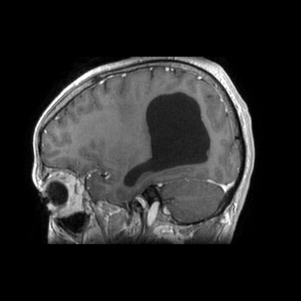 File:Central neurocytoma (Radiopaedia 67618-77021 Sagittal T1 C+ 8).jpg