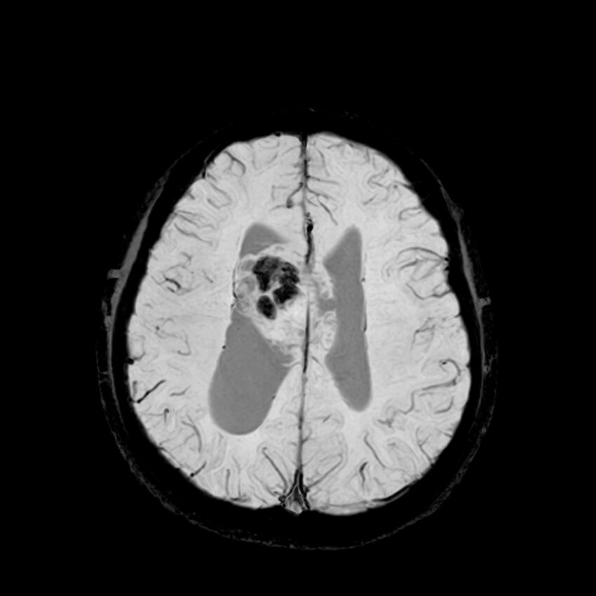 Central neurocytoma (Radiopaedia 79320-92380 Axial SWI 97).jpg