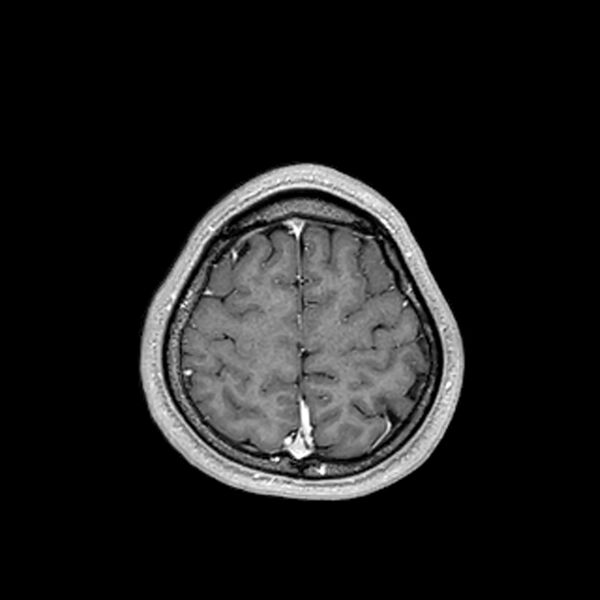 File:Central neurocytoma (Radiopaedia 79320-92380 Axial T1 C+ 198).jpg