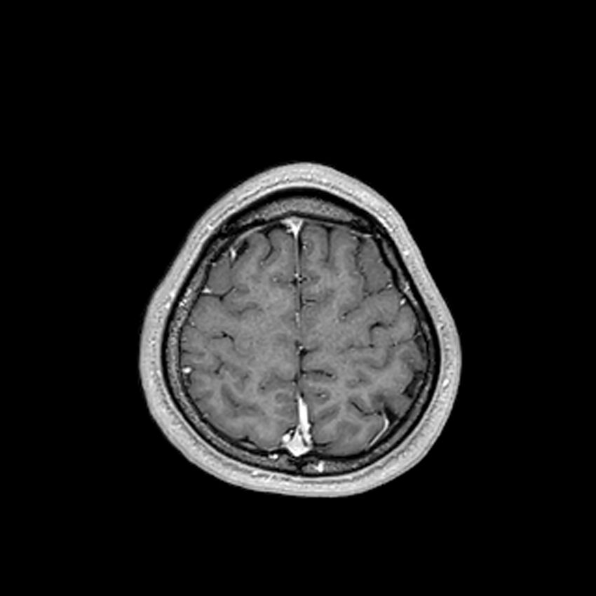 Central neurocytoma (Radiopaedia 79320-92380 Axial T1 C+ 198).jpg