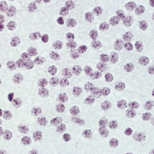 File:Central neurocytoma (histology) (Radiopaedia 36368).jpg