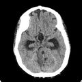 Cerebellar abscess secondary to mastoiditis (Radiopaedia 26284-26412 Axial non-contrast 58).jpg