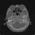 Cerebellar abscess secondary to mastoiditis (Radiopaedia 26284-26413 Axial bone window 37).jpg