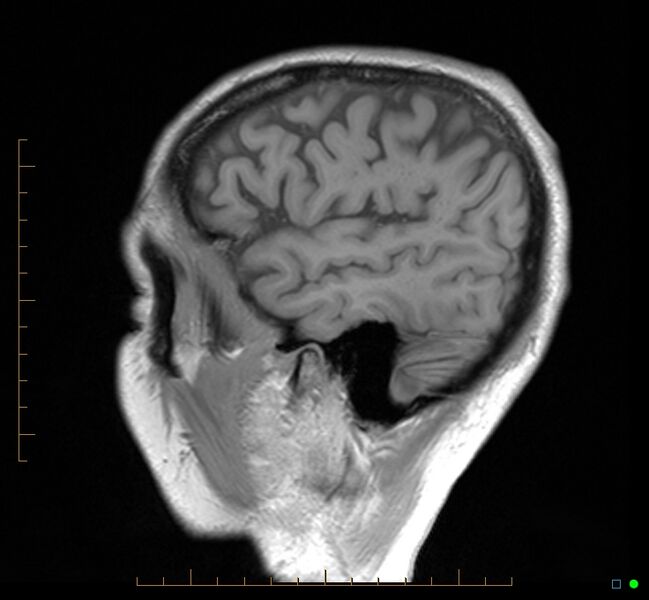 File:Cerebellar gangliocytoma (Radiopaedia 65377-74422 Sagittal T1 6).jpg