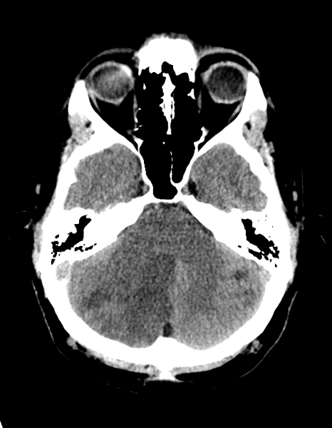 File:Cerebellar infarct due to vertebral artery dissection with posterior fossa decompression (Radiopaedia 82779-97030 Axial non-contrast 10).png
