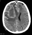 Cerebral abscesses secondary to contusions (Radiopaedia 5201-6967 Axial C+ delayed 3).jpg