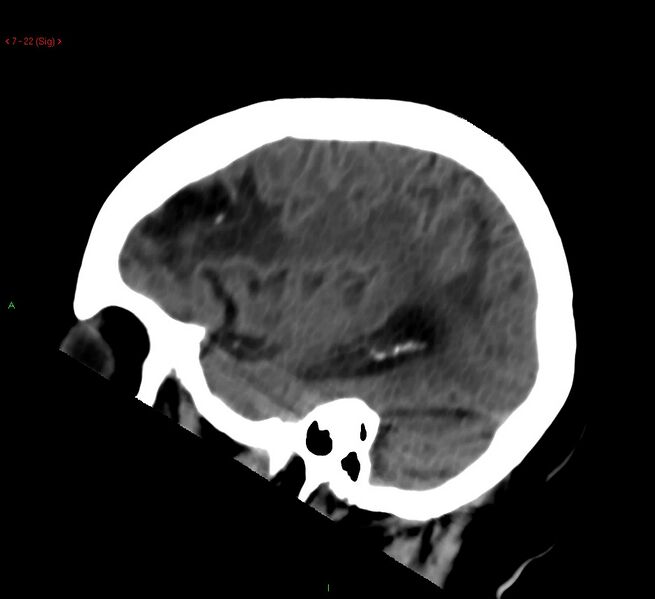 File:Cerebral amyloid angiopathy-associated lobar intracerebral hemorrhage (Radiopaedia 58378-65518 C 22).jpg