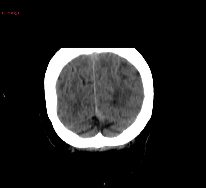 Cerebral amyloid angiopathy-associated lobar intracerebral hemorrhage (Radiopaedia 58378-65518 Coronal non-contrast 20).jpg
