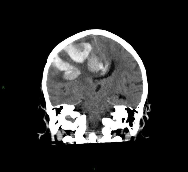 File:Cerebral amyloid angiopathy-associated lobar intracerebral hemorrhage (Radiopaedia 58560-65723 Coronal non-contrast 35).jpg