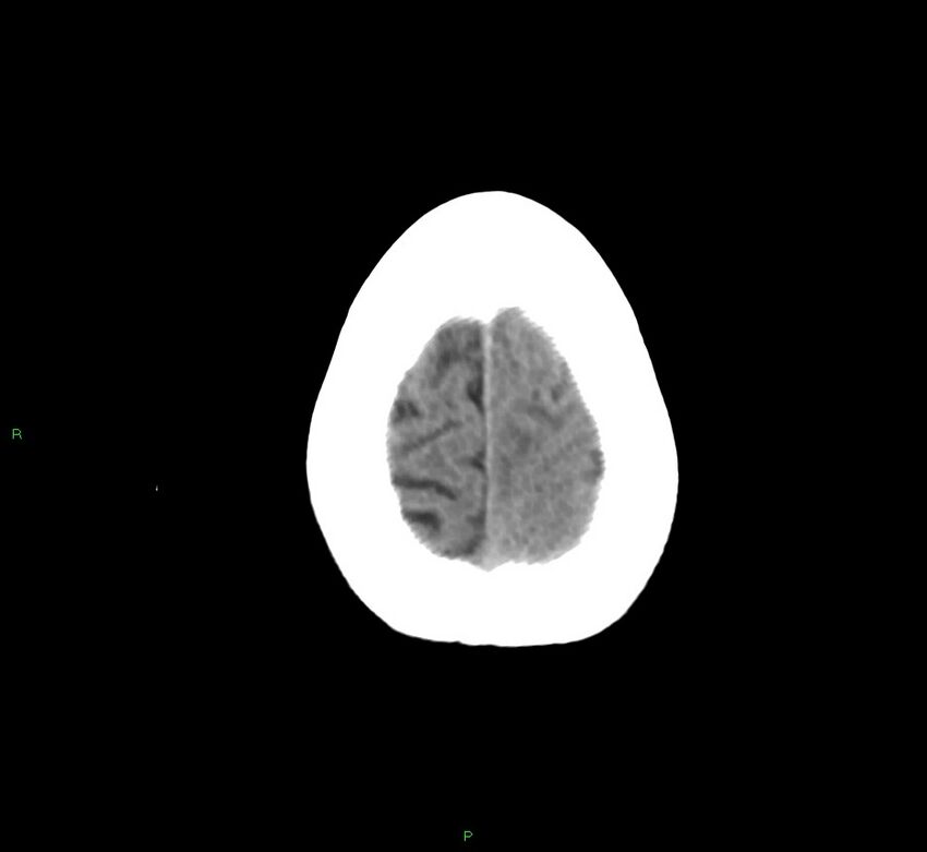 Cerebral amyloid angiopathy-associated lobar intracerebral hemorrhage (Radiopaedia 58754-65975 Axial non-contrast 14).jpg