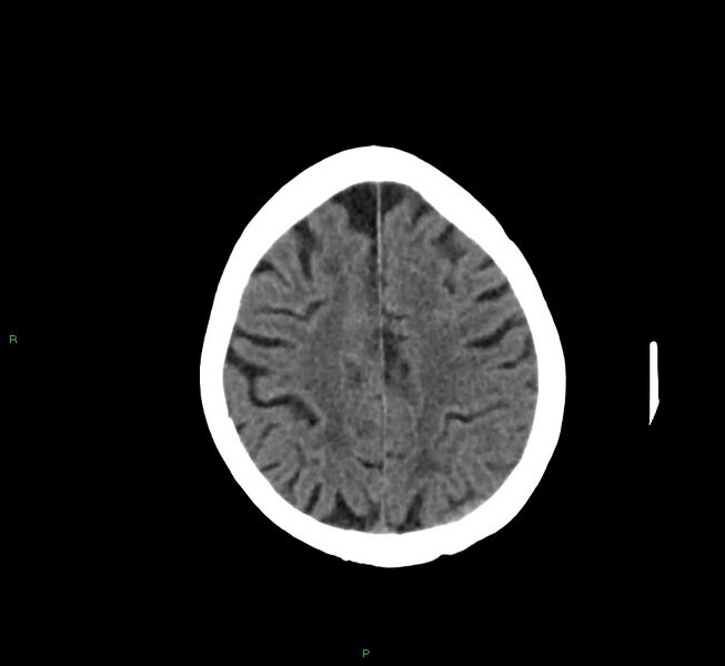 File:Cerebral amyloid angiopathy-associated lobar intracerebral hemorrhage (Radiopaedia 58757-65978 Axial non-contrast 15).jpg