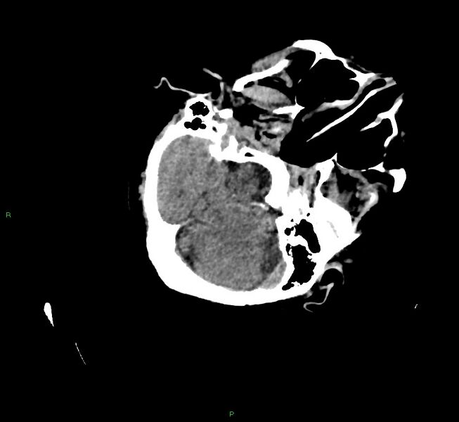 File:Cerebral amyloid angiopathy-associated lobar intracerebral hemorrhage (Radiopaedia 58757-65979 Axial non-contrast 34).jpg