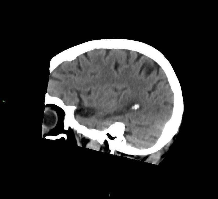Cerebral amyloid angiopathy-associated lobar intracerebral hemorrhage (Radiopaedia 58758-65980 C 40).jpg