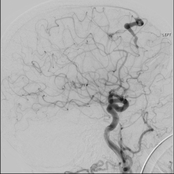 File:Cerebral arteriovenous malformation with lobar hemorrhage (Radiopaedia 44725-48513 LT CCA IC 36).png
