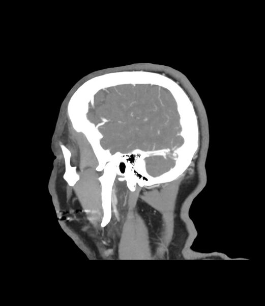 File:Cerebral dural venous sinus thrombosis (Radiopaedia 86514-102576 C 3).jpg