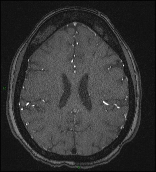 File:Cerebral fat embolism (Radiopaedia 35022-36525 Axial TOF 135).jpg