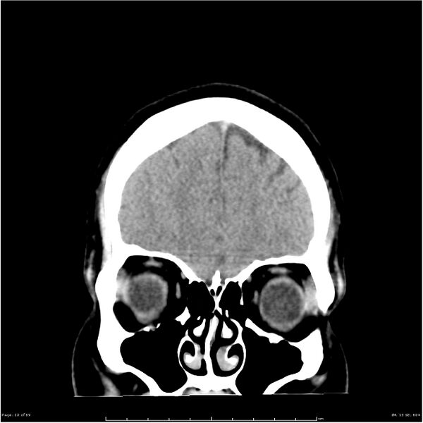 File:Cerebral hemorrhage secondary to arteriovenous malformation (Radiopaedia 33497-34561 Coronal non-contrast 3).jpg