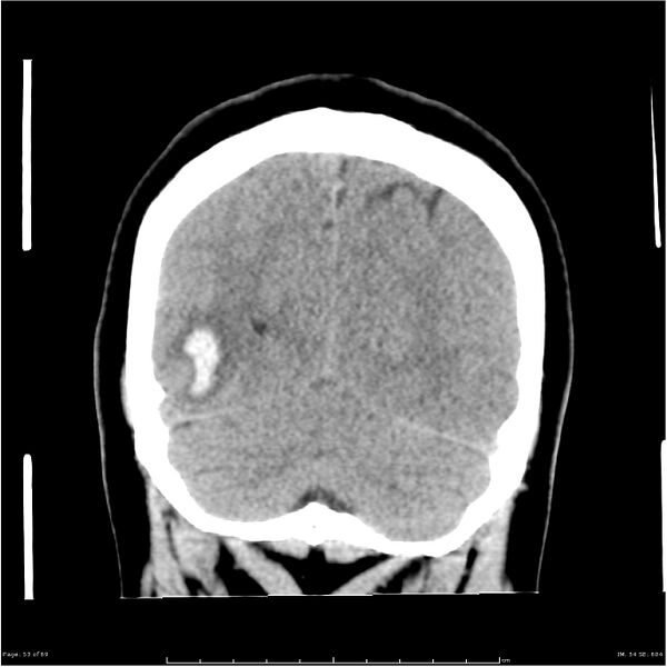 File:Cerebral hemorrhage secondary to arteriovenous malformation (Radiopaedia 33497-34561 Coronal non-contrast 44).jpg