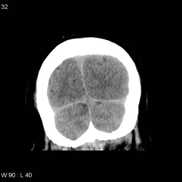 File:Cerebral hemorrhagic contusion with subdural and subarachnoid hemorrhage (Radiopaedia 10680-11146 Coronal non-contrast 17).jpg