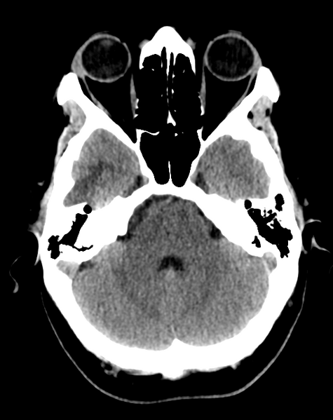 File:Cerebral venous infarct related to dural venous sinus thromboses (Radiopaedia 35292-36803 AXIAL THICK 7).png