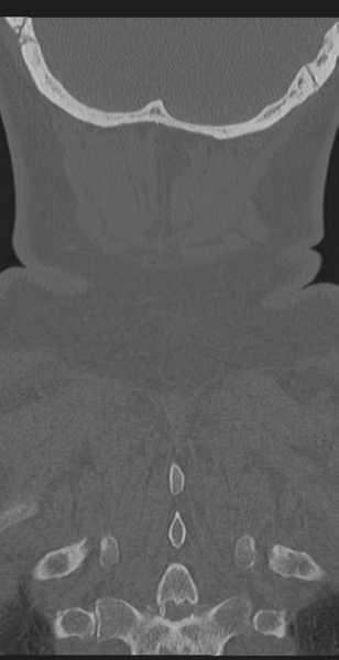 File:Cervical canal stenosis - OPLL and osteophytes (Radiopaedia 47329-51910 Coronal bone window 63).png