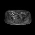Cervical carcinoma (Radiopaedia 78847-91705 Axial T1 C+ fat sat 5).jpg